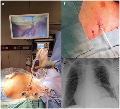 Minimally invasive epicardial left-ventricular lead implantation and simultaneous left atrial appendage closure